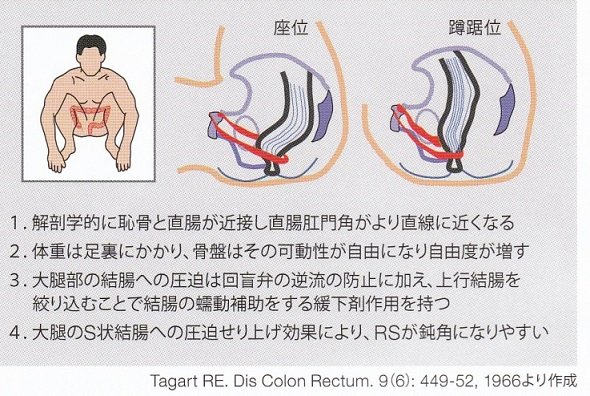 うんこが出づらいときは足を組んで力めばすぐに出る